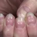 неровные ногти на руке
